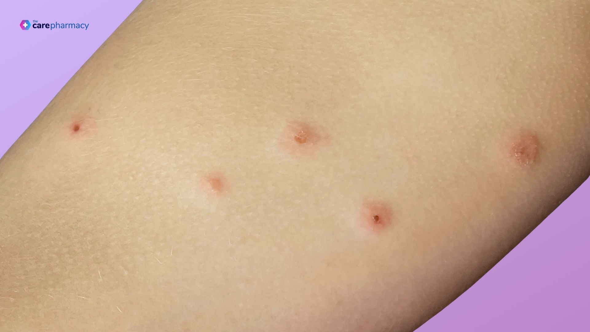 View Impetigo Treatments Online Impetigo Treatment View Impetigo Treatments Online Impetigo Treatment