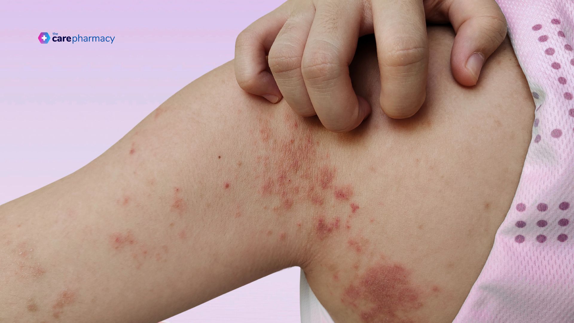 Impetigo on patient's arm