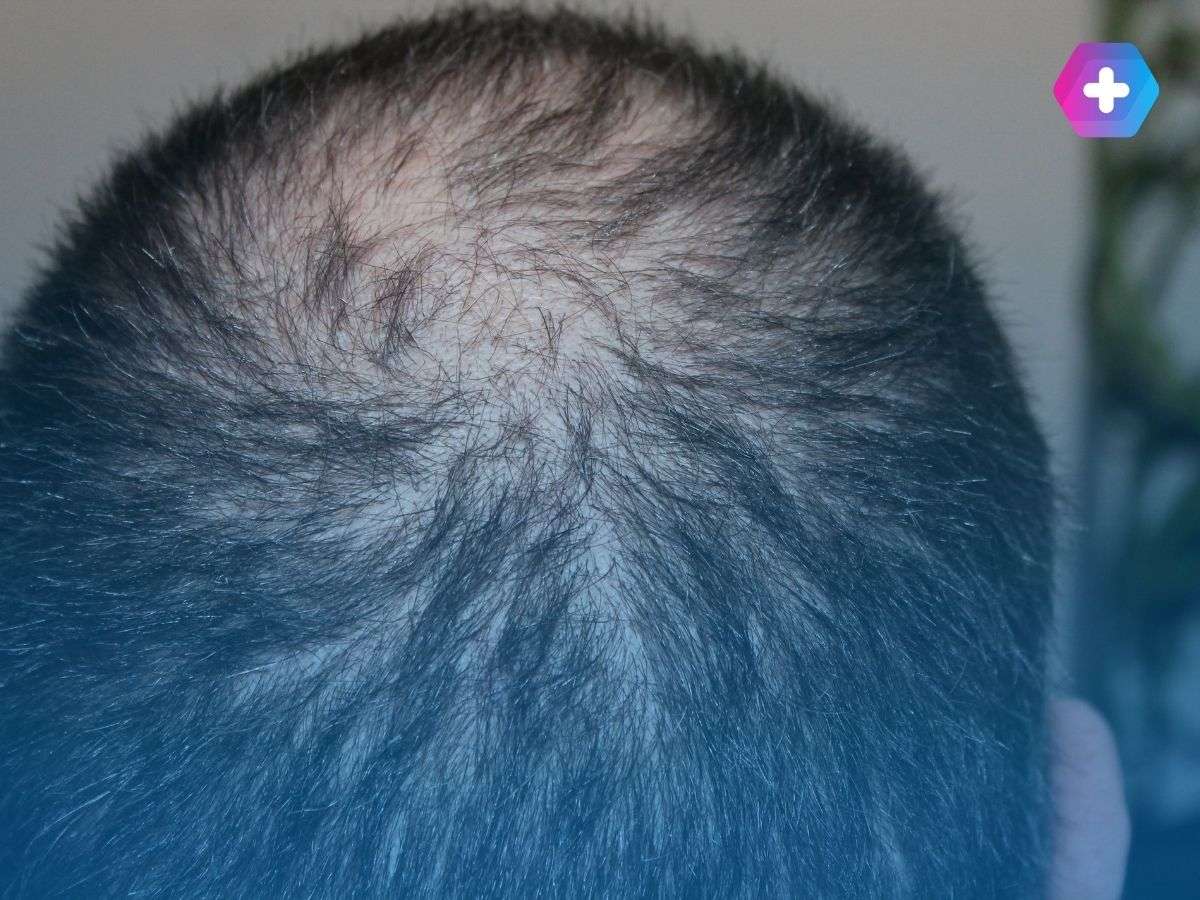 does finasteride work for male pattern baldness?