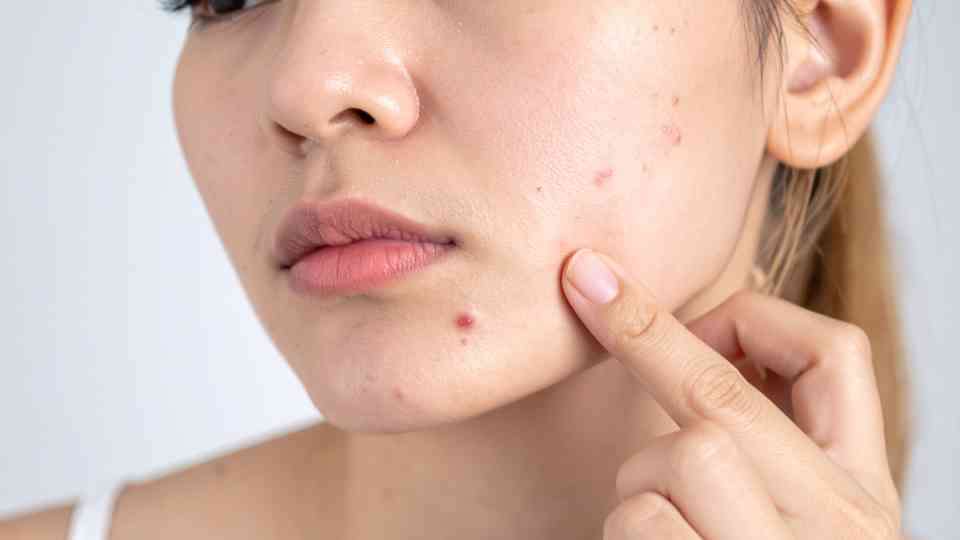 woman pointing to acne spots on her face