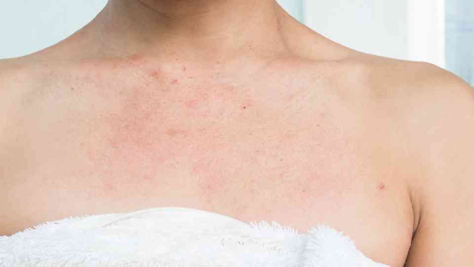 close-up of eczema rash on woman