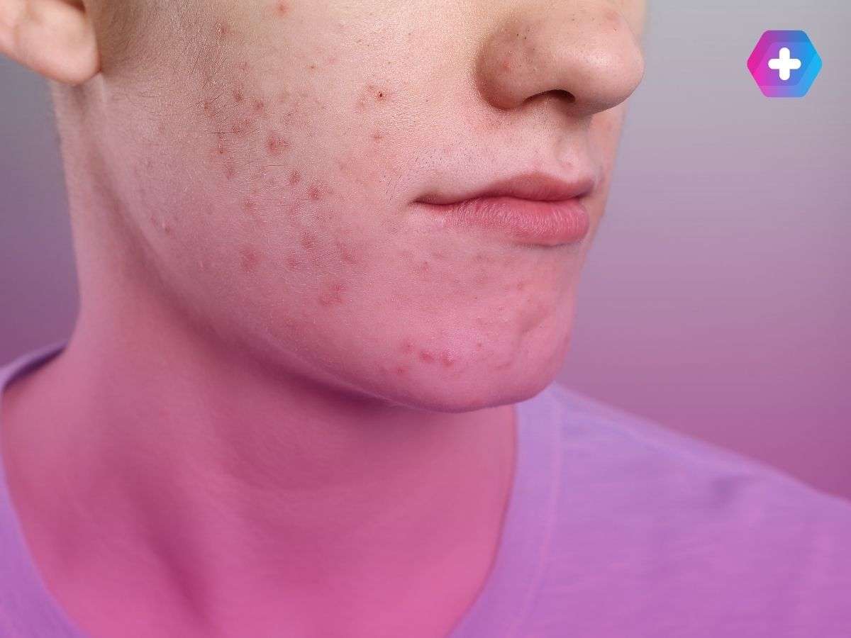young man with acne on his face