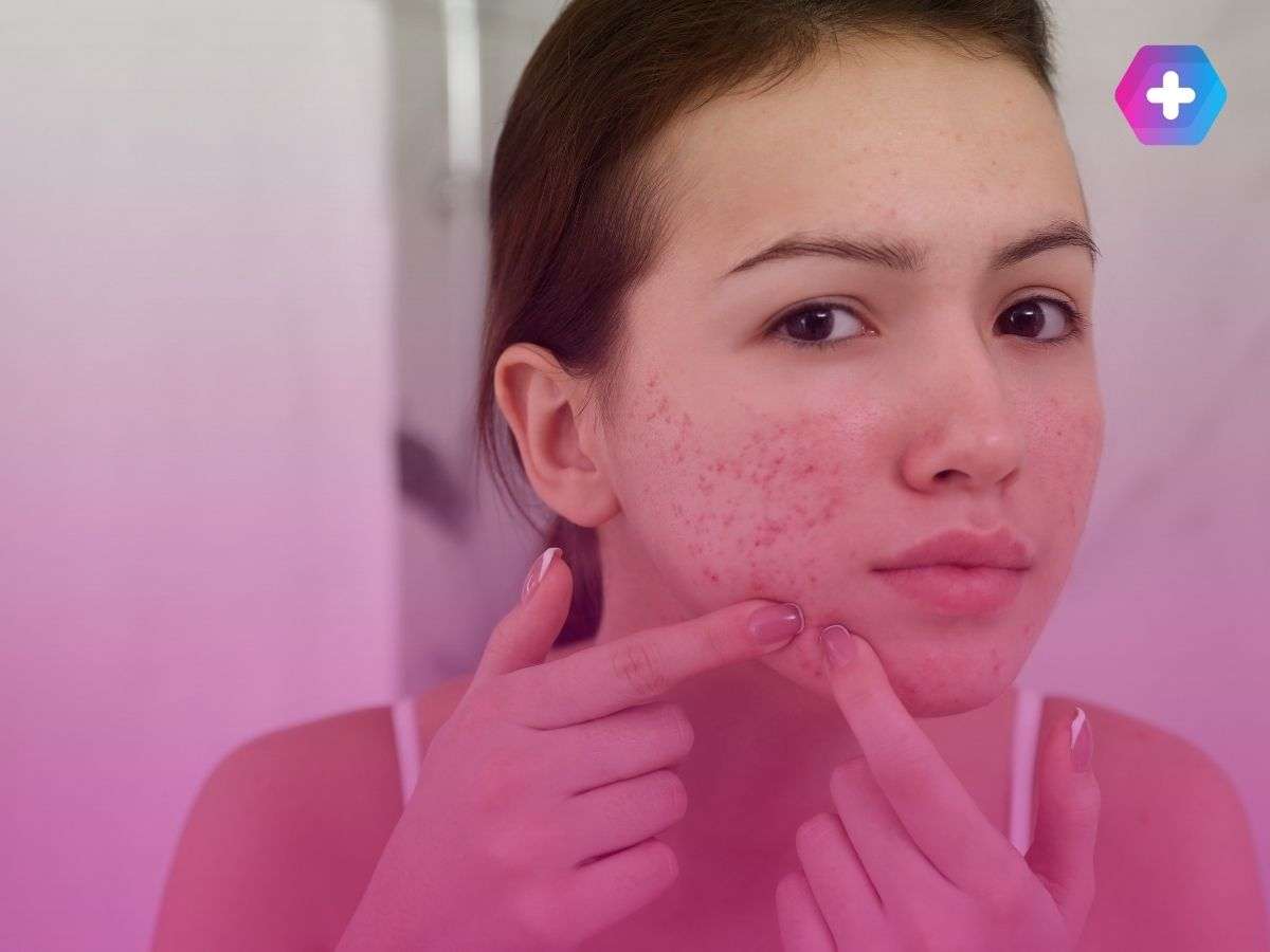 young woman pointing to acne spots on her face