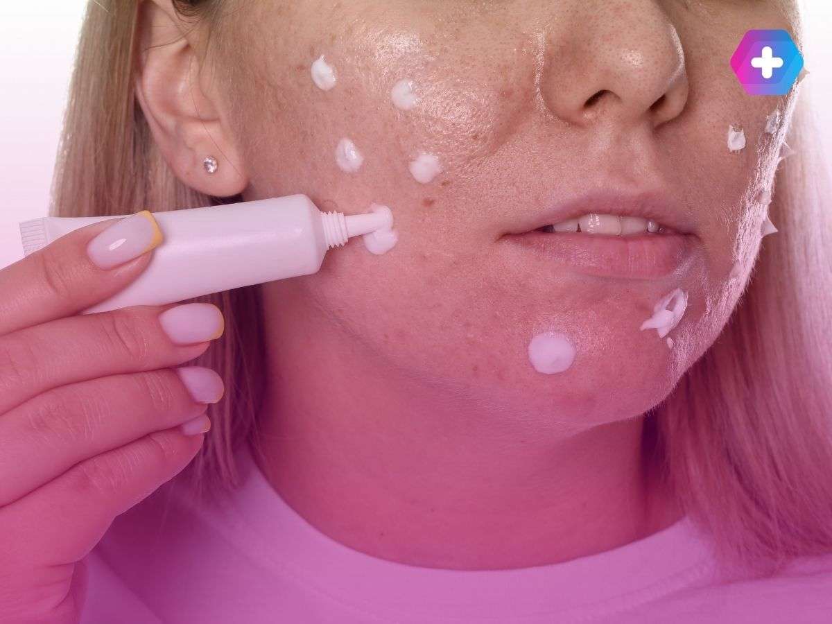 woman putting acne cream in spots on her face