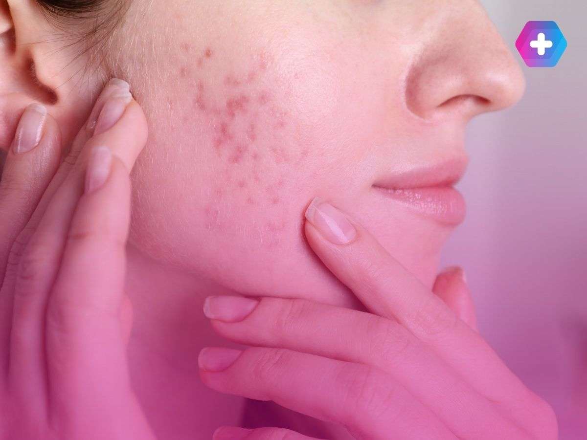woman with acne on her face