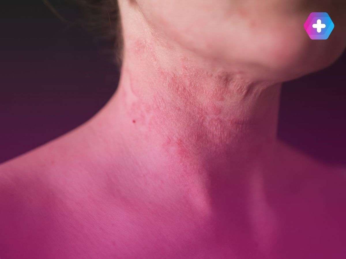 person with rash on their neck