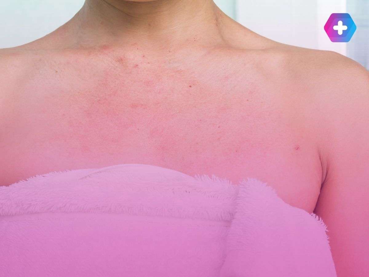woman with rash on her chest
