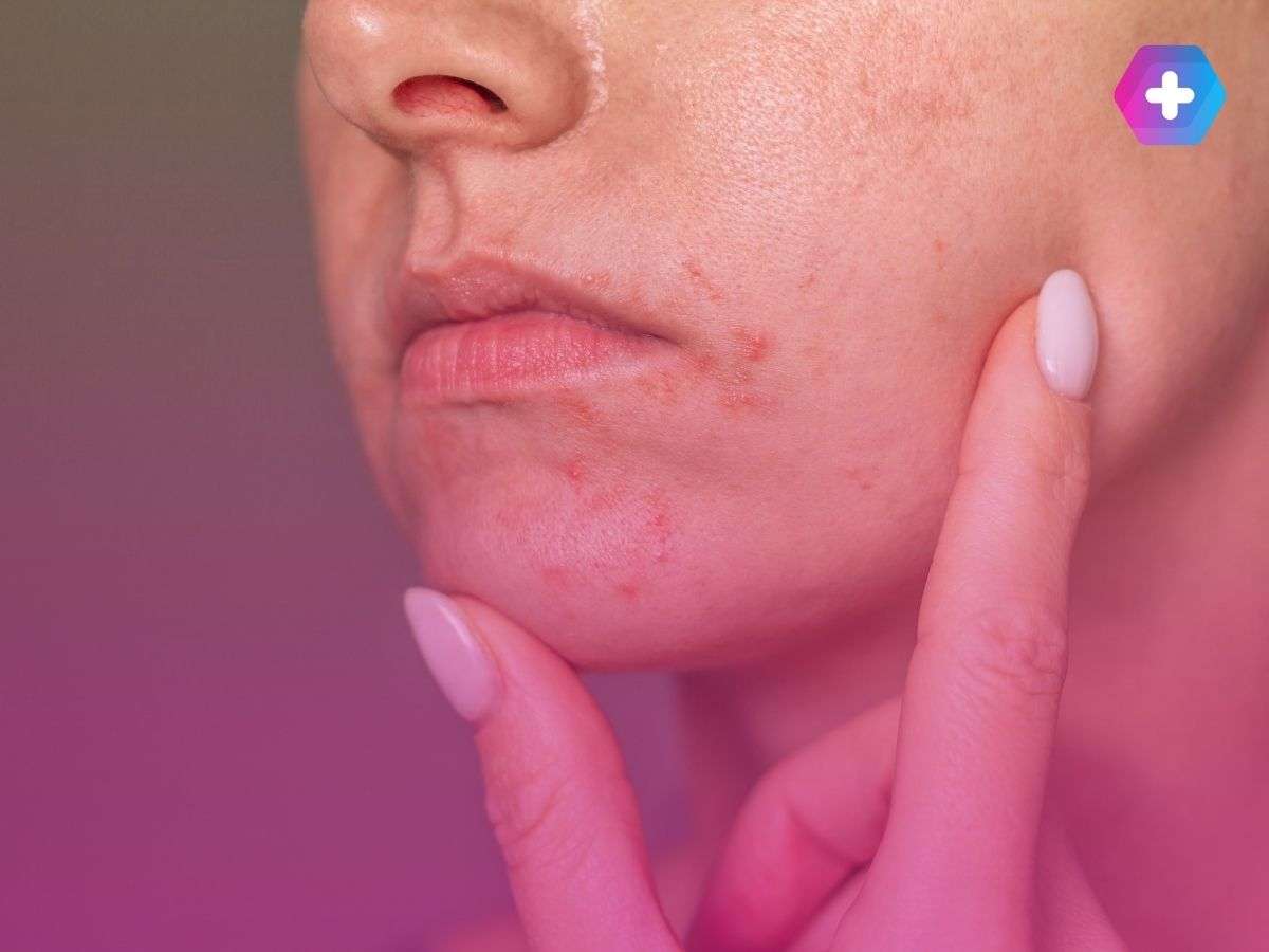 person with redness on their face