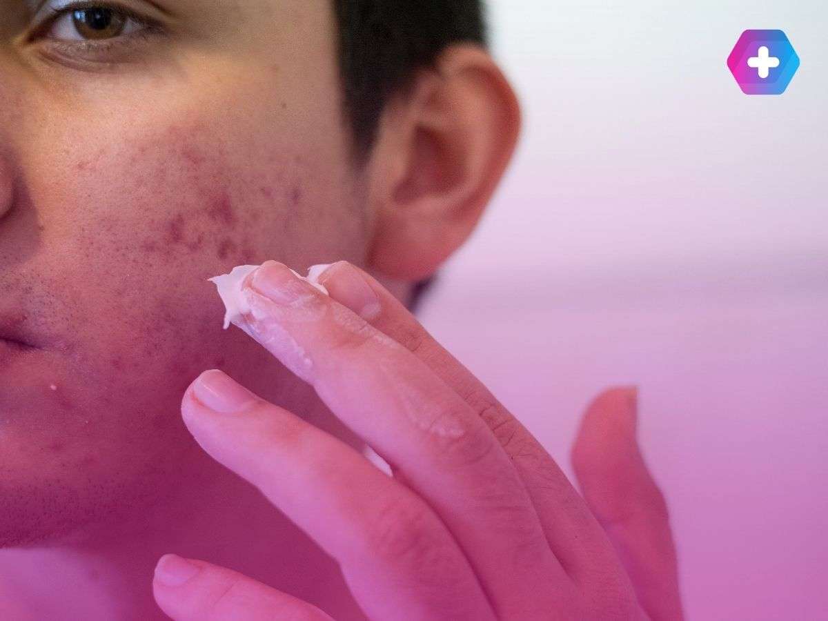 young man applying cream to acne spots in his face