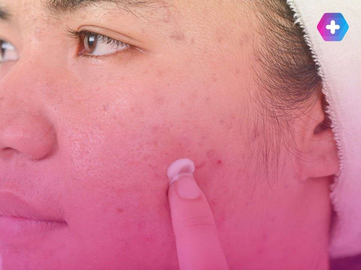 patient applying cream to acne spots on their face