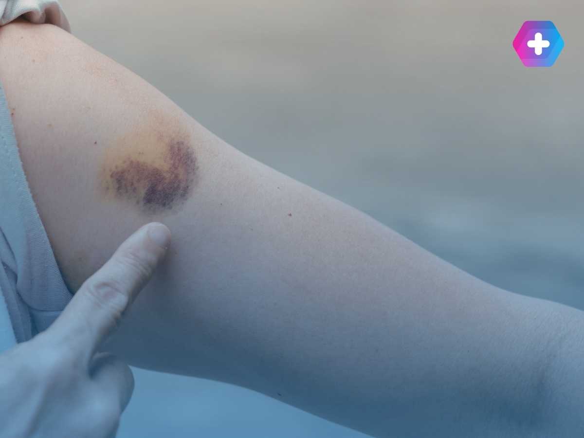 Bruise from weight loss injections