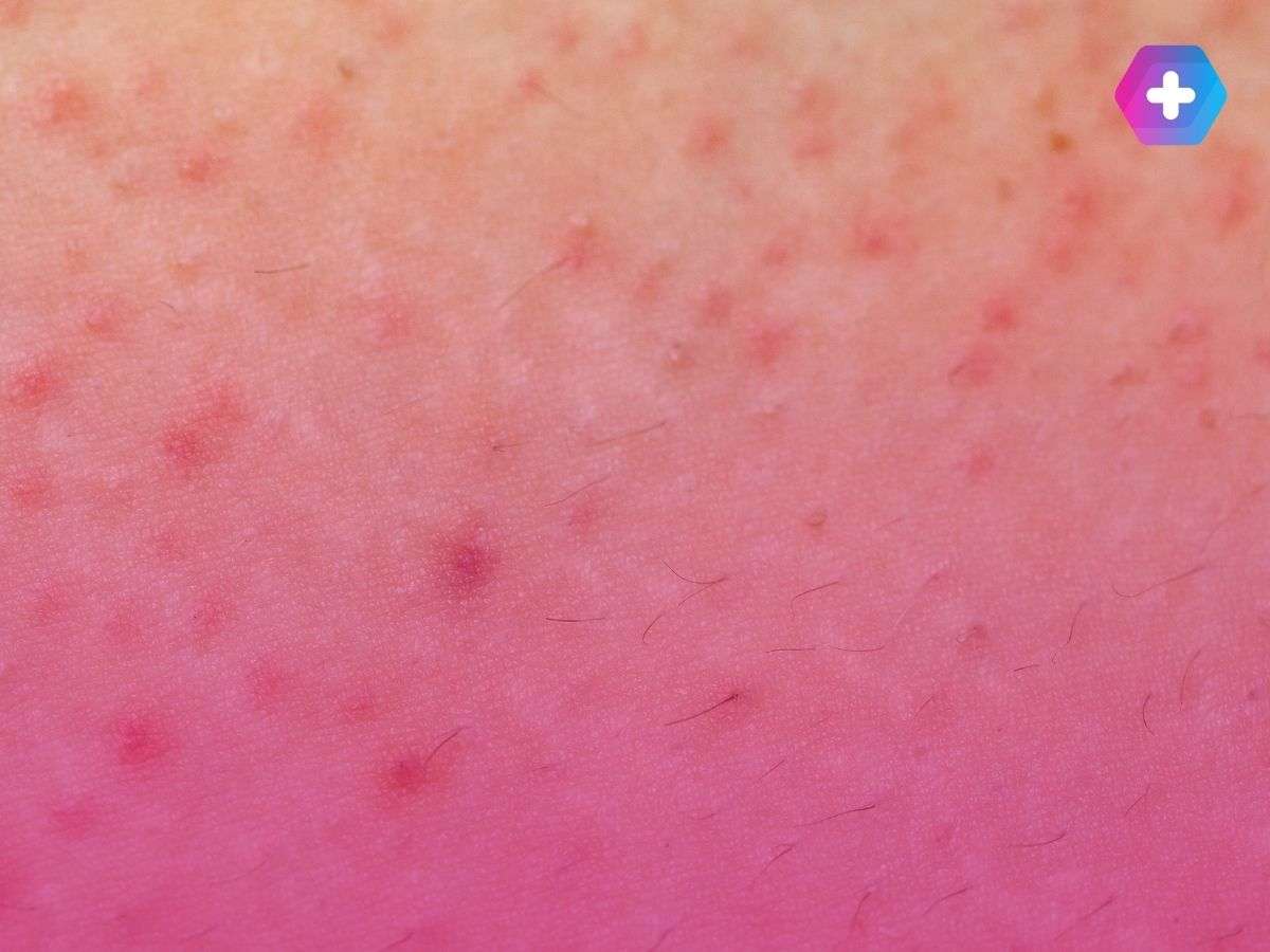 close-up of acne spots on skin