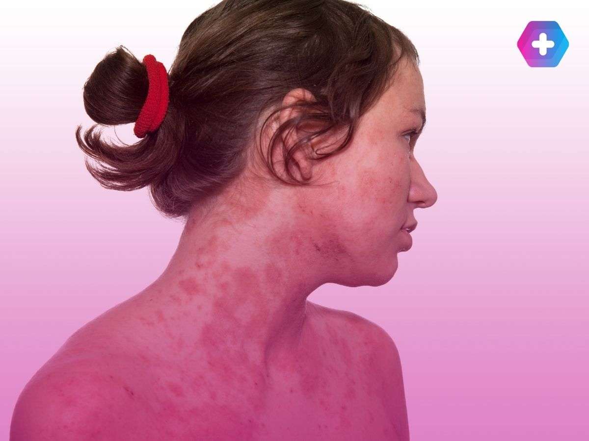 young woman with severe eczema on face, neck, and shoulders