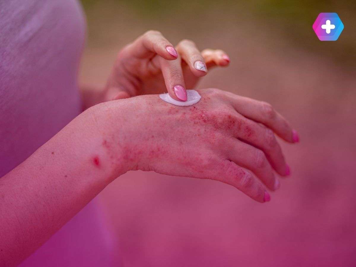 person applying cream to rash on their hand