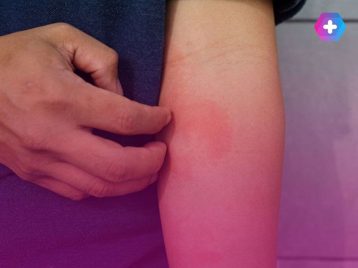 person scratching eczema rash on their arm