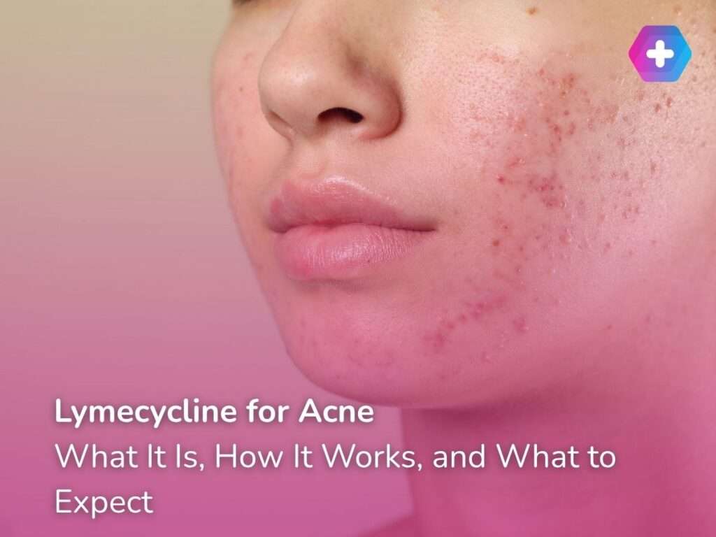 Lymecycline for Acne: What It Is, How It Works, and What to Expect